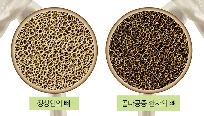 여드름관리