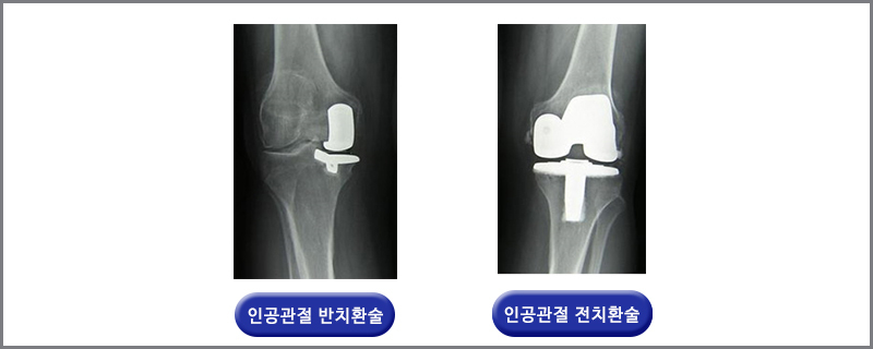 여드름관리