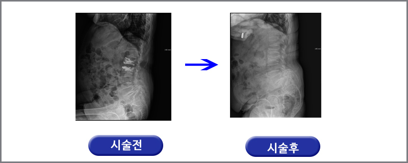 여드름관리
