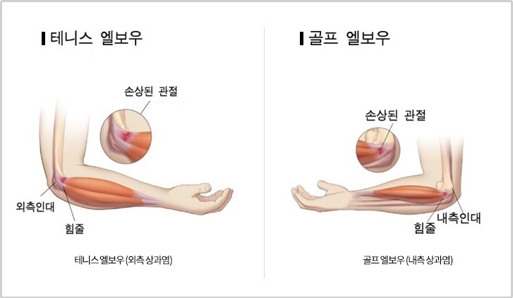 여드름관리